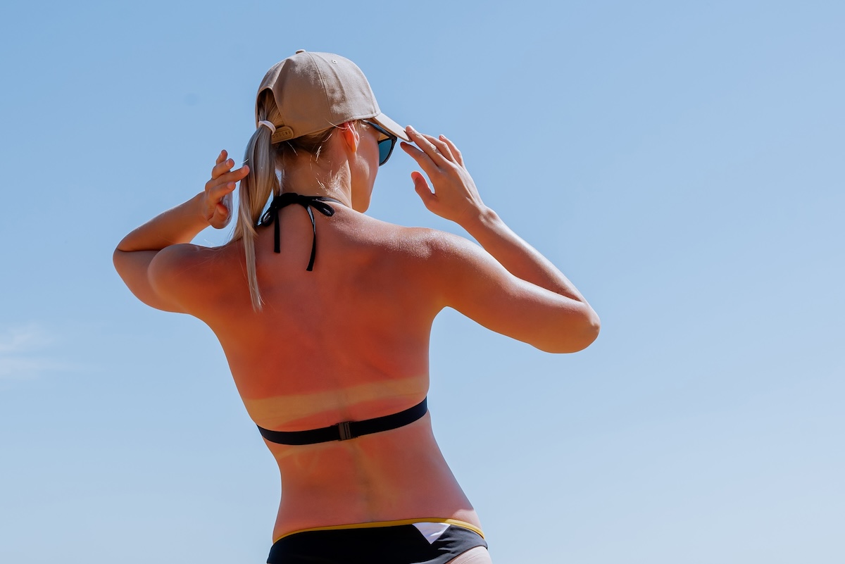 Shutterstock: Woman in cap got a Sunburn. Red painful skin on back that feels hot to the touch after beach visits in blue sky background. Use Sunscreen or UV protection cream. Back view