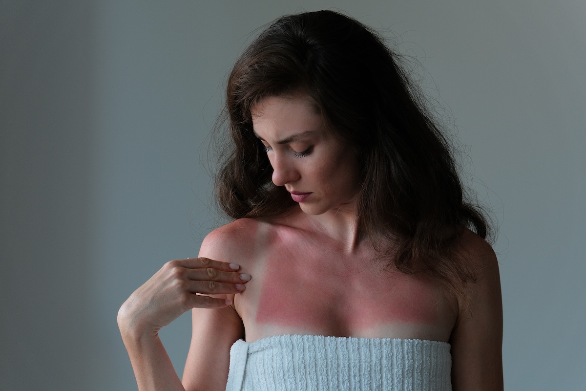 Shutterstock: Woman with a severe sunburn wrapped in a towel, pointing at her red and irritated skin, highlighting sun damage